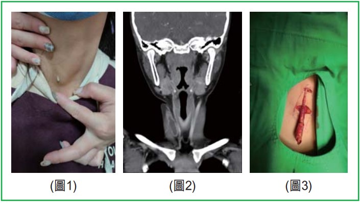 頸部第二對腮裂囊腫(Branchial cleft cyst)表徵和治療