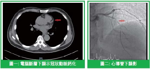 認識冠狀動脈疾病—及早檢查，守護心臟健康