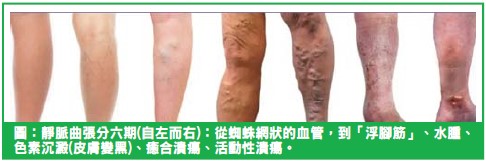 不只是「浮腳筋」！淺談靜脈曲張：從下肢水腫到皮膚潰瘍