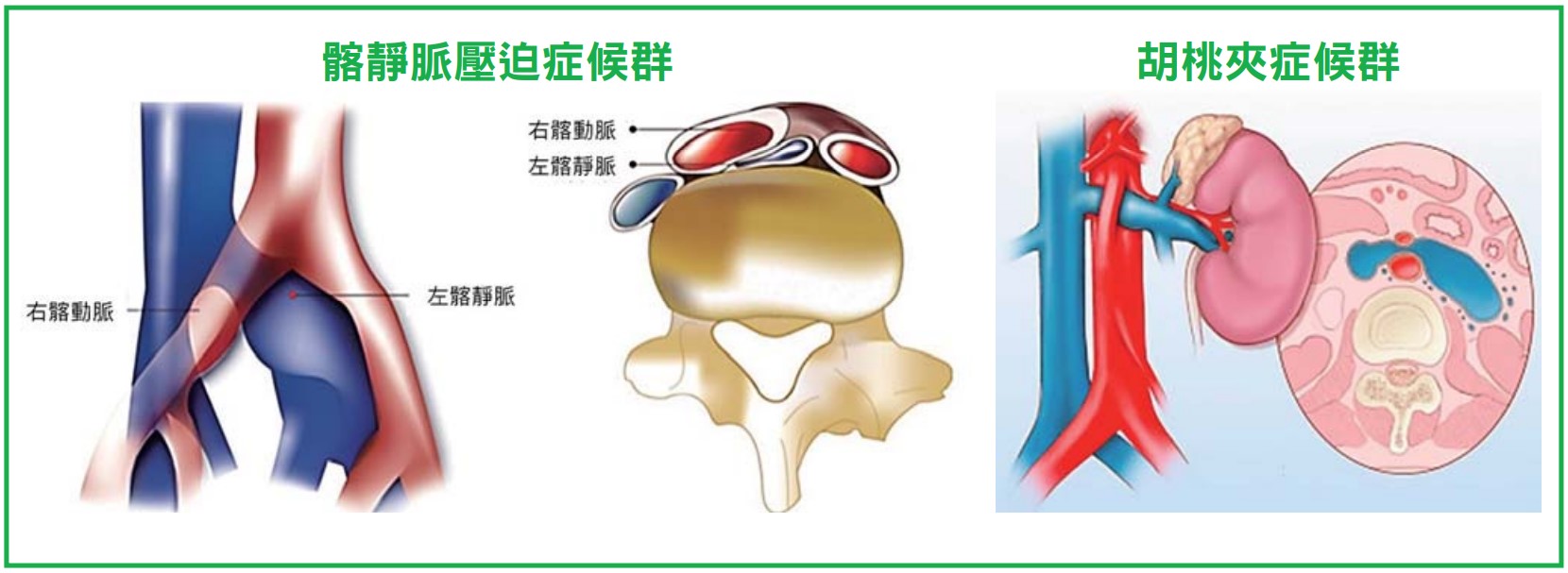 容易被忽略卻常見的靜脈疾病