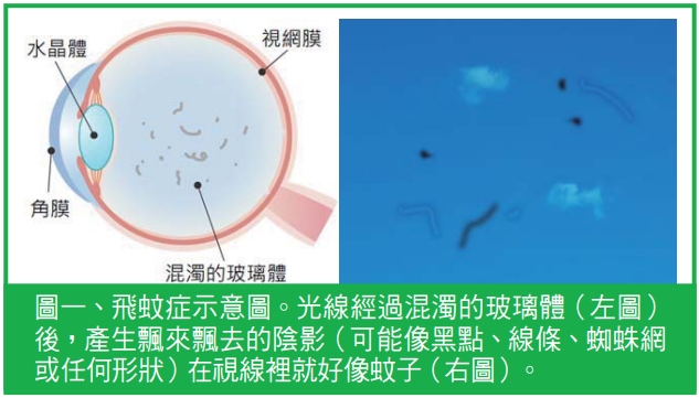 小黑點大警訊！飛蚊症懶人包