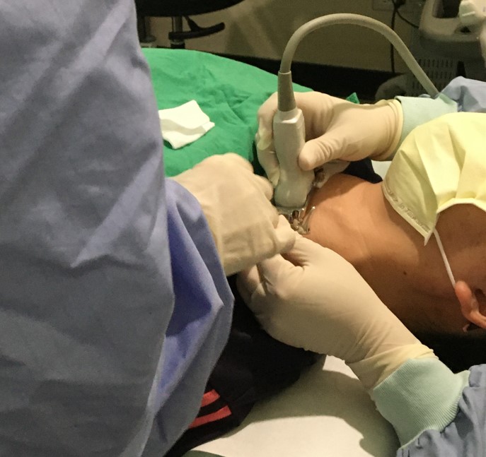 精準微創新選擇──甲狀腺射頻消融術（RFA）