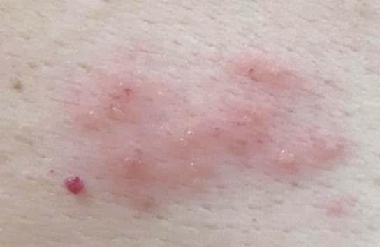 解開帶狀皰疹的神秘面紗