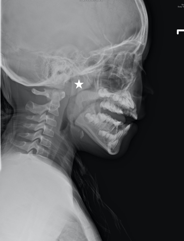 只是打鼾 竟然也會影響生長發育和學習？──認識兒童睡眠呼吸中止症