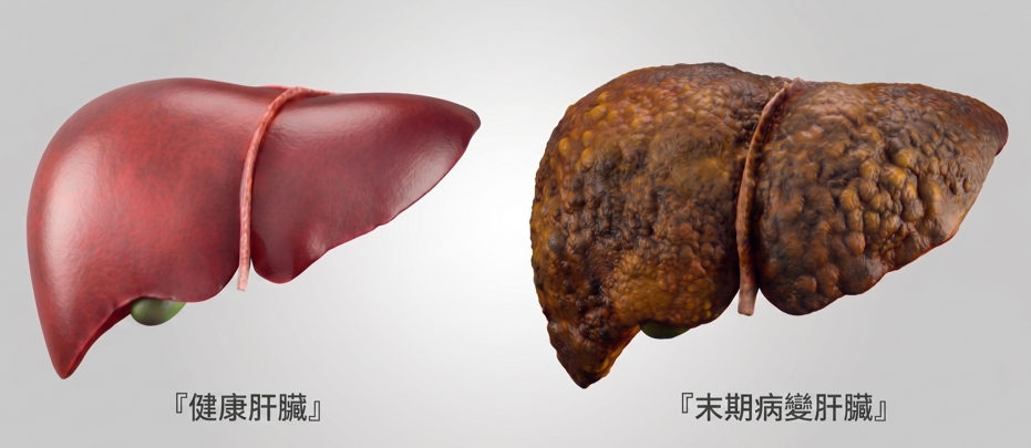拿回生活的主控權, 我該評估肝臟移植嗎?