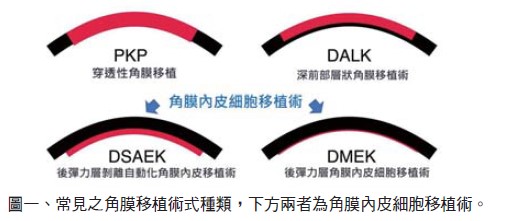 重拾清晰視野:認識角膜移植手術與現代趨勢