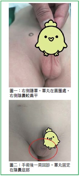 淺談隱睪症