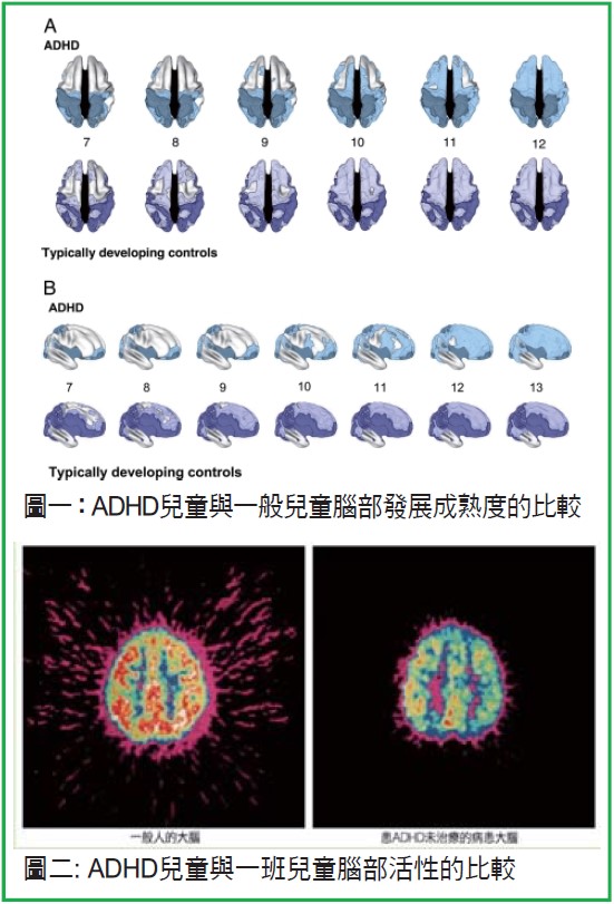分心不是我的錯 –認識注意力不足過動症(ADHD)