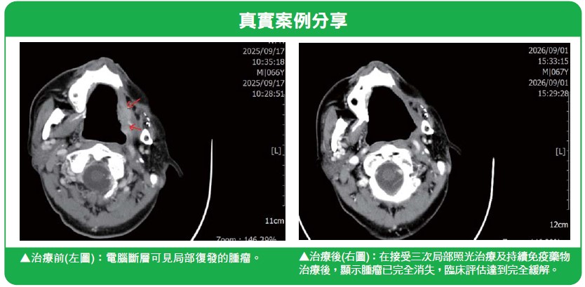 認識前列腺癌 從磁振造影檢查到融合導引切片