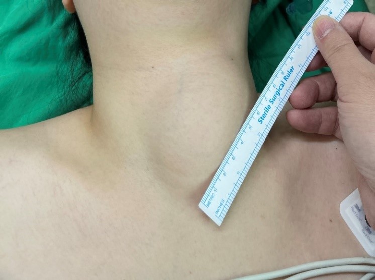 8公分甲狀腺結節免傳統開刀 RFA治療半年縮小逾9成 甩開「脖子卡卡」